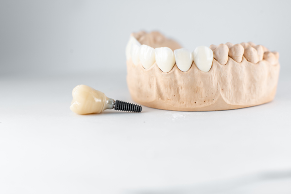 How Long Do Dental Implants Crowns Last?